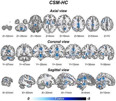 Neural Correlates of Cognitive Dysfunctions in Cervical Spondylotic Myelopathy Patients: A Resting-State fMRI Study